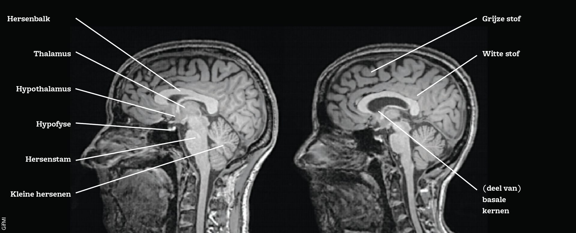 Mannen en vrouwen hebben andere hersenen. Hoog tijd om daar echt